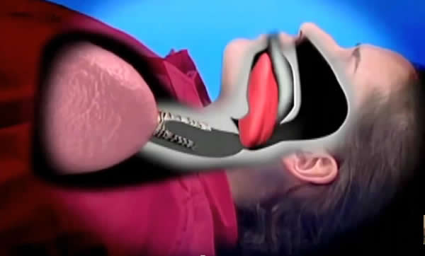 كيفية إنقاذ شخص بلع لسانه