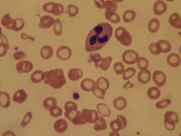 Anemia فقر الدم